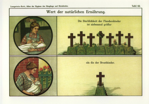 Säuglingsflasche oder Mutterbrust? Die Ratgeber in der ersten Hälfte des 20. Jahrhunderts ließen keinen Zweifel an der richtigen Antwort. (aus: Leopold Langstein/Fritz Rott, Atlas der Hygiene des Säuglings und Kleinkindes, Berlin 1918, Tafel 62. Siehe zu diesem Werk Luisa Rittershaus, Visualisierung in der Säuglingsfürsorge Anfang des 20. Jahrhunderts. Der »Atlas der Hygiene des Säuglings und Kleinkindes«, Göttingen 2013.)