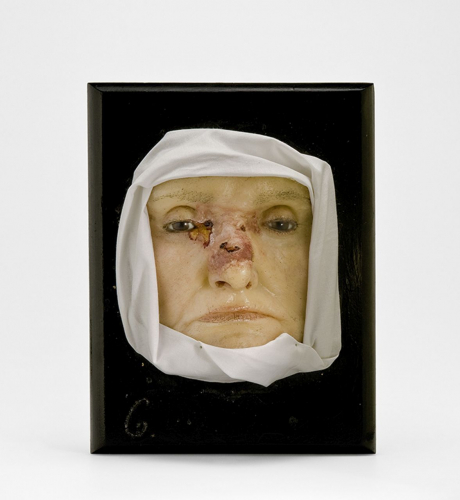 Augenmoulage, nach 1900, Hersteller (Mouleur): Fritz Kolbow, Berlin. Diese Wachsmoulage wurde zu Beginn des 20. Jahrhundert als Lehr- und Studienmittel an der Charité-Augenklinik nach klassischer Technik gefertigt: Der Mouleur nahm zunächst von der darzustellenden Gesichtspartie des Patienten ein Gipsnegativ ab, goss dieses mit flüssigem Wachs aus, entnahm die erkaltete Wachsschale und bereitete sodann die Rohmoulage unter Sicht des Patienten durch Retuschieren, Bemalen und Einfügen von Fremdmaterialien, wie etwa Kunstaugen oder Haaren, realistisch auf. (Berliner Medizinhistorisches Museum der Charité, Inv.-Nr. 2007/M6; Foto: Christoph Weber, Berlin)